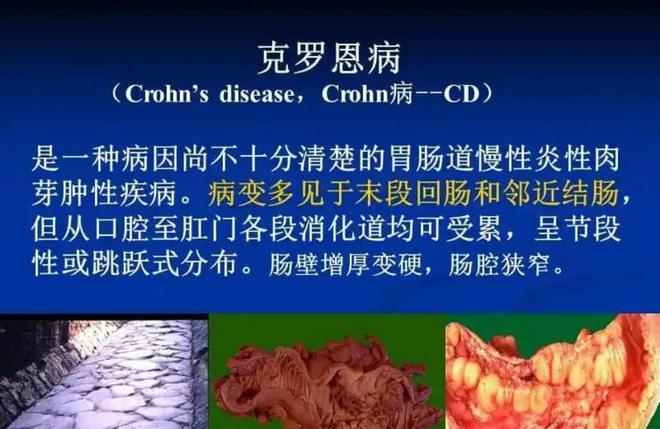 克罗恩病肠镜表现_克罗恩肠道病理_肠镜疑似克罗恩