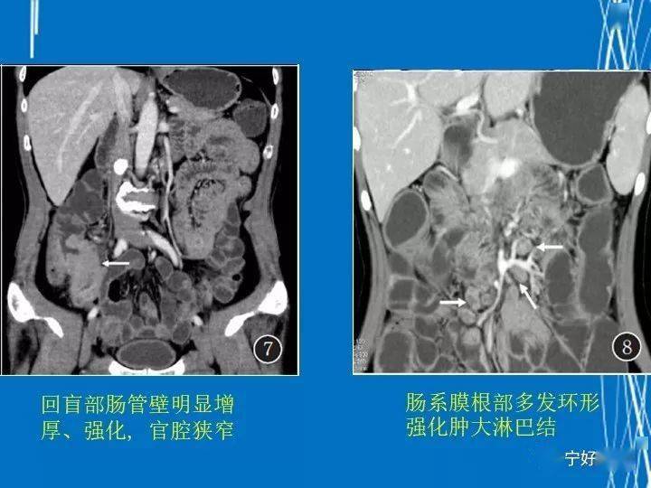 针尖样瞳孔见于哪些病_回盲部线样征见于什么病_盲见什么意思