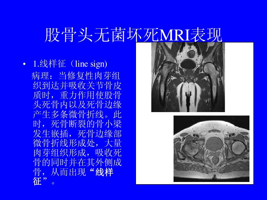 回盲部线样征见于什么病_针尖样瞳孔见于哪些病_盲见什么意思