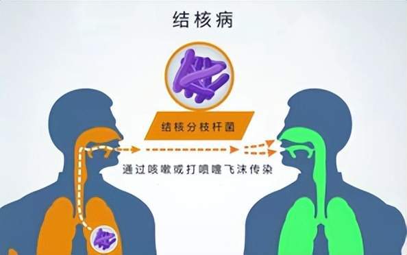 肺传染结核型会复发吗_三型肺结核会传染吗_肺结核传染就会发病吗